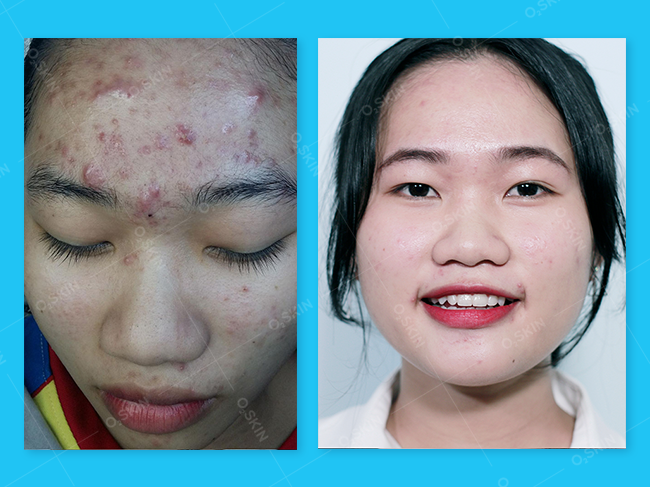 Tình trạng da trước và sau khi Peel da của bạn Anh Quý