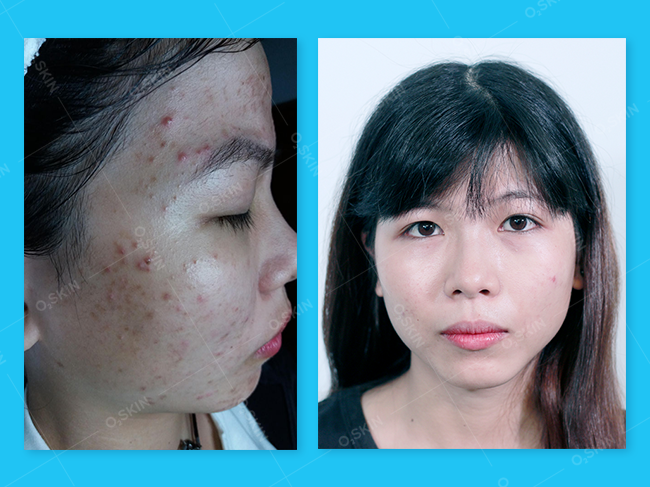 Hình ảnh trước và sau khi Peel da tại O2 SKIN của bạn Trần Thị Hương