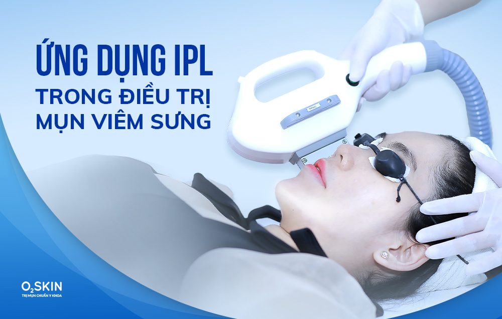 Công nghệ IPL ứng dụng phổ biến trong điều trị mụn và kiểm soát nhờn hiệu quả (430nm).