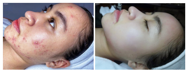 Tình trạng da trước và sau khi điều trị mụn của Tường Duy