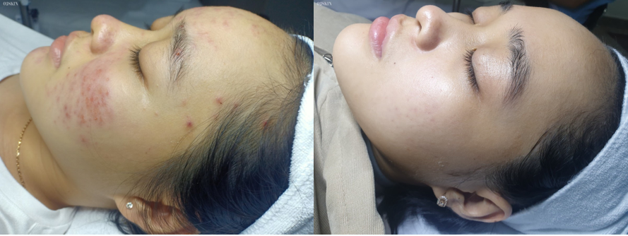 Tình trạng da trước và sau khi điều trị mụn của Khánh Vy.
