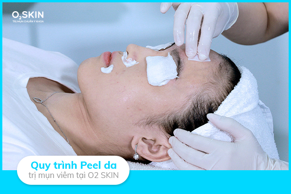 Quy trình Peel da trị mụn viêm tại O2 SKIN.