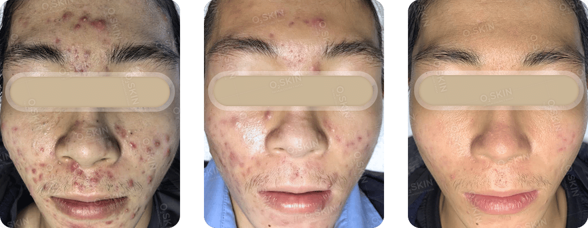 Hiệu quả điều trị – Hình ảnh khách hàng Nguyễn Đặng Quang Minh