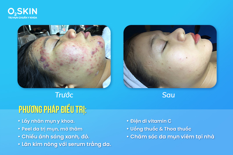 Làn da mụn viêm, mụn bọc của Lâm Nhi đã được cải thiện hơn 90%.