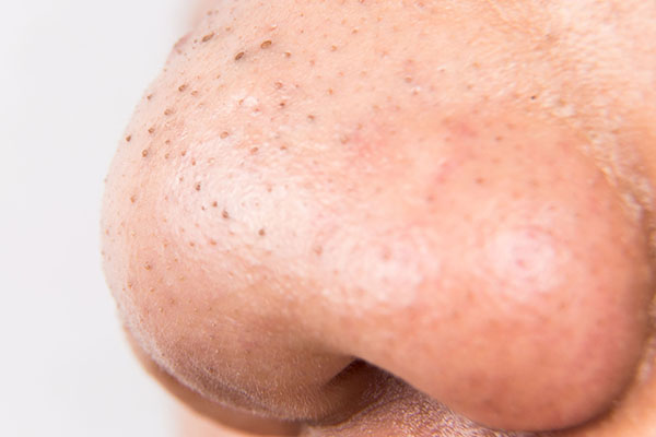8 bước nặn mụn đầu đen tại nhà để tránh gây hại da