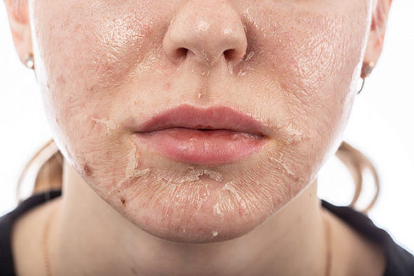 Peel da kích thích tế bào da bong tróc và tái tạo làn da mới
