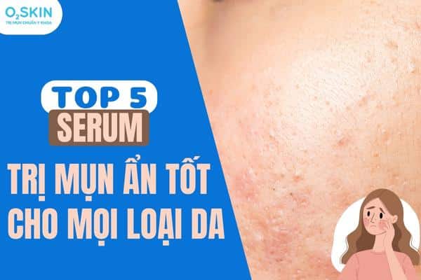 Top 5 serum trị mụn ẩn tốt nhất cho mọi loại da