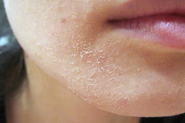 Bong tróc da thường xảy ra khi bắt đầu sử dụng Retinol