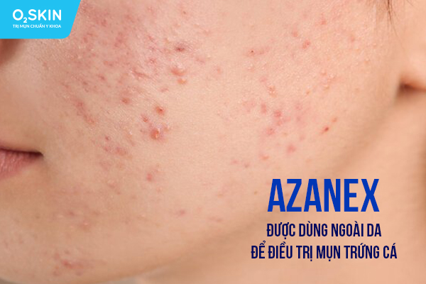 Azanex được dùng ngoài da để điều trị mụn trứng cá