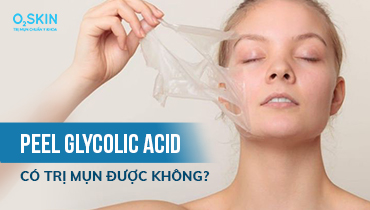 Glycolic Acid có an toàn cho da mụn hay không