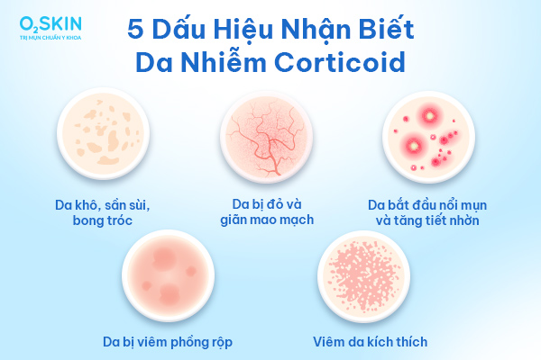 5 dấu hiệu nhận biết da nhiễm Corticoid