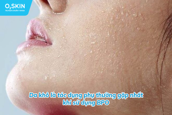 Da khô là tác dụng phụ thường gặp nhất khi sử dụng BPO
